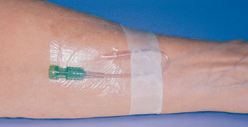 Tube For Intravenous Fluids Injections To Implantable Port For